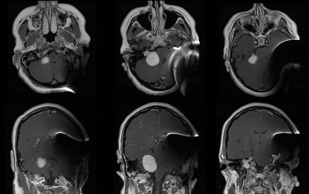 MRI Auditory Brainstem Implant