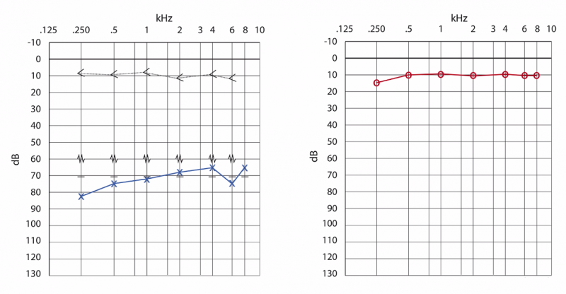 Conductive Hearing Loss