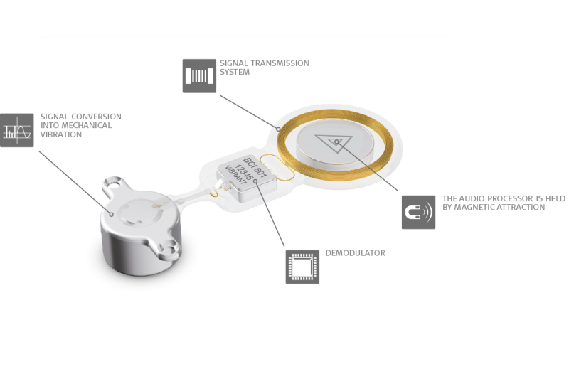 BONEBRIDGE Active Bone Conduction Implant