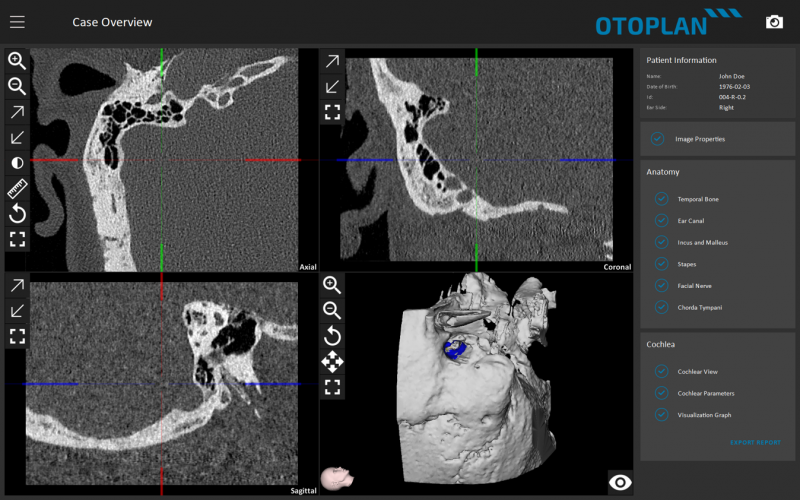 OTOPLAN 3D otological DICOM view