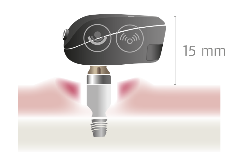 BAHA bone conduction implant