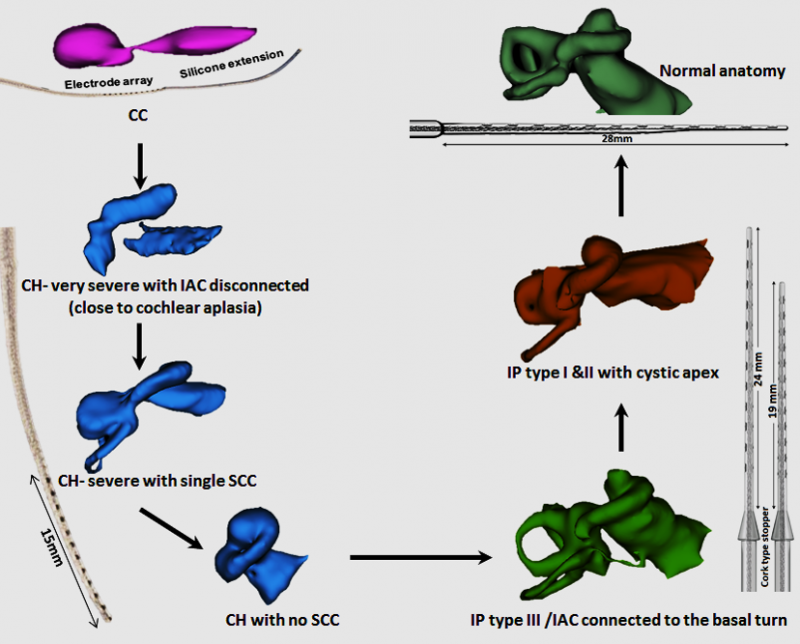 Electrode arrays cochlea malformations