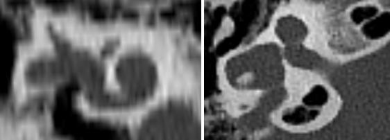 incomplete partition type 1 cochlea