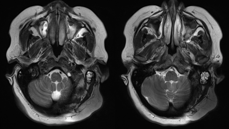 MRI head scans SYNCHRONY cochlear implant 3 Tesla