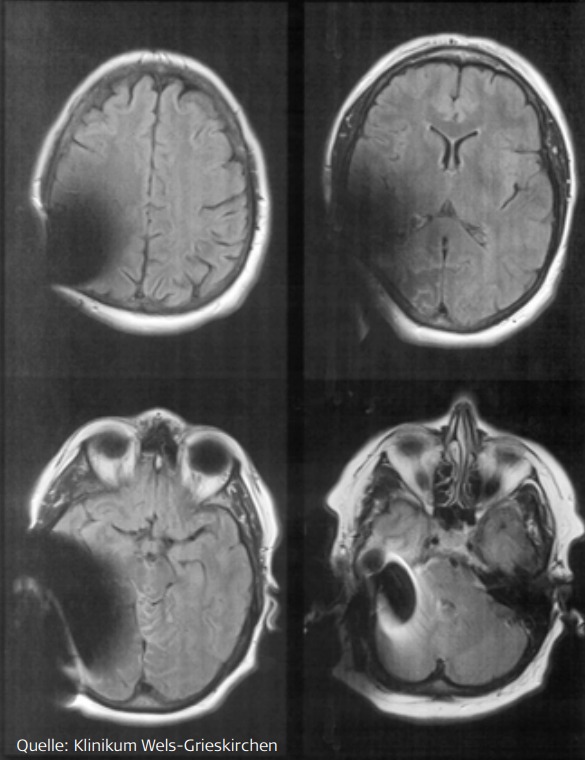 MRI with VIBRANT SOUNDBRIDGE