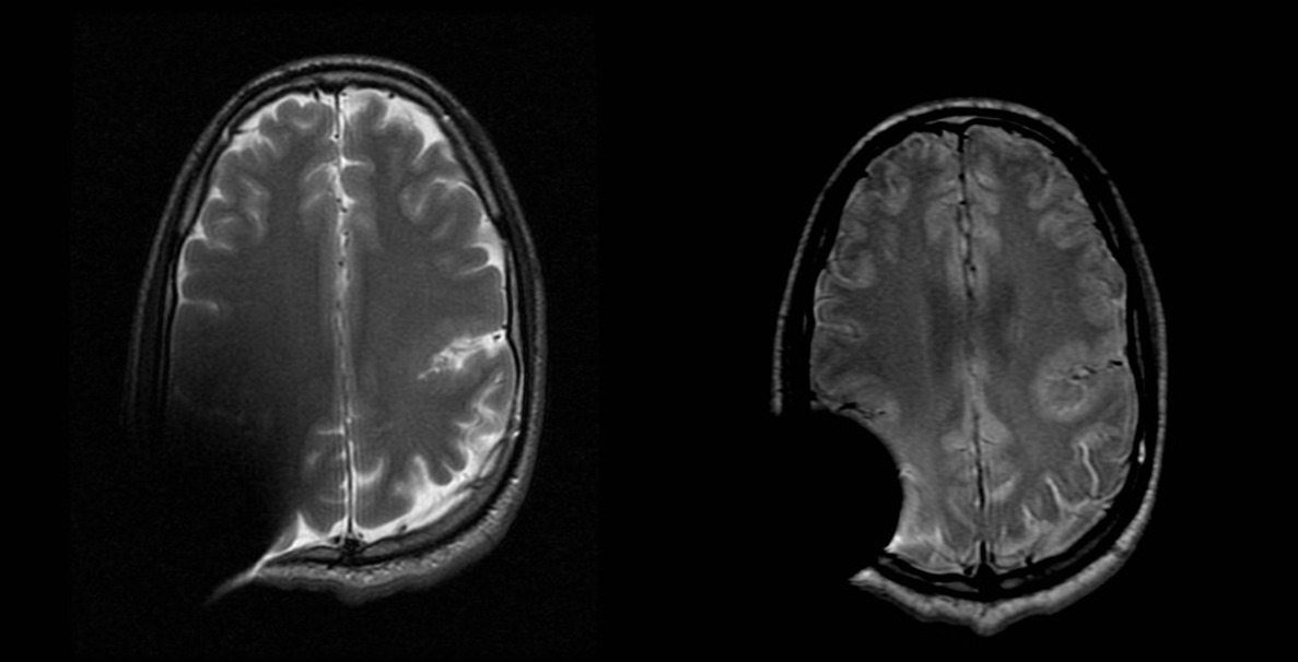 Axial T2 and Axial PD MAVRIC showing bilateral silvian fissure polymicrogyria in patient with a middle ear implant