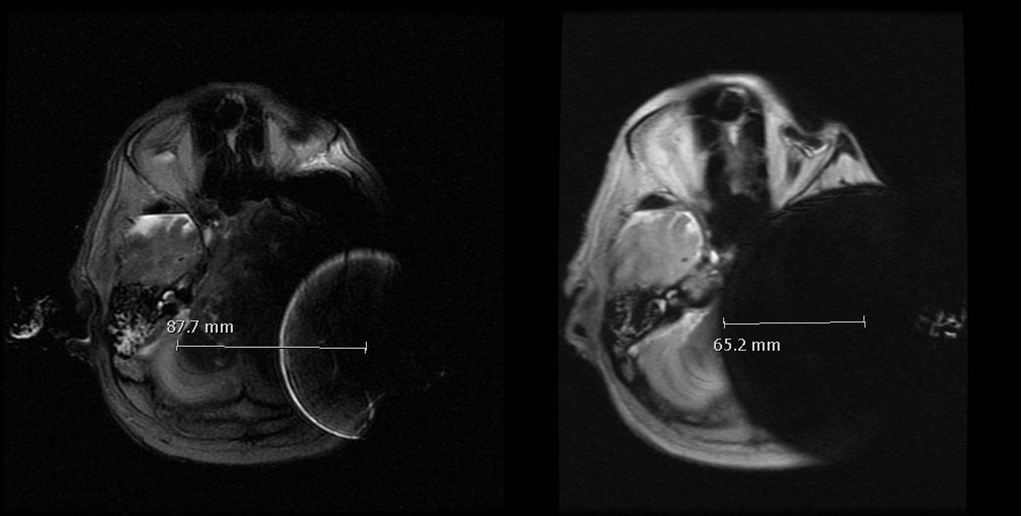 Axial T2 (left) vs MAVRIC (right). BCI 601 middle fossa placement