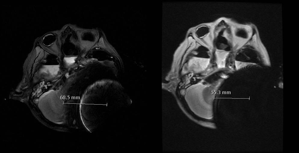 Axial T2 (left) vs MAVRIC (right). BCI 601 sinodural placement