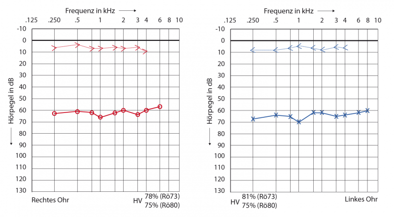 Conductive hearing loss audiogram bilateral VIBRANT SOUNDBRIDGE Middle Ear Implants