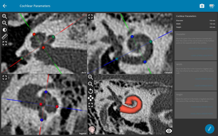 OTOPLAN cochlear parameters