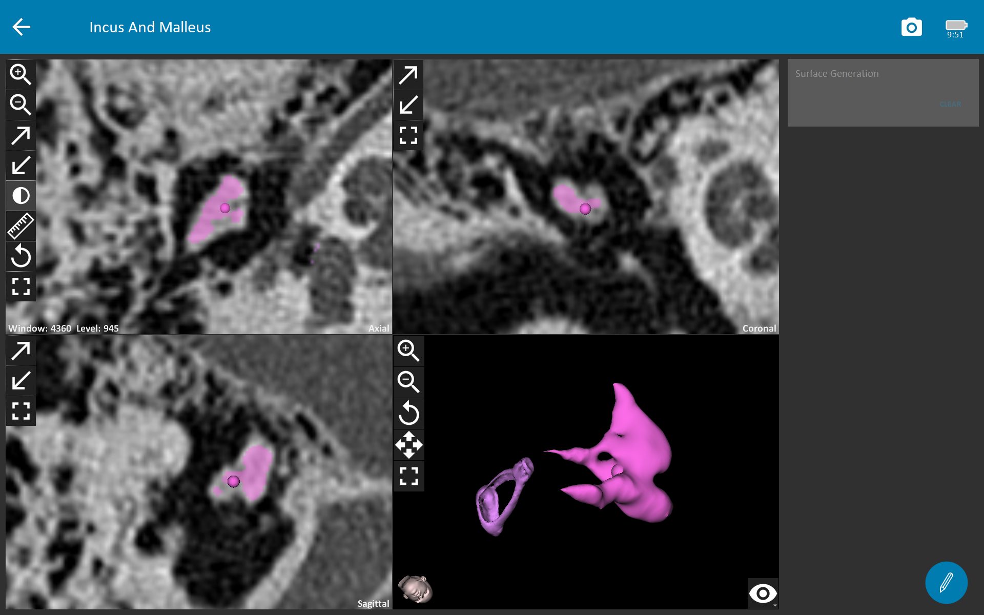 Measure stapes and ossicles with OTOPLAN