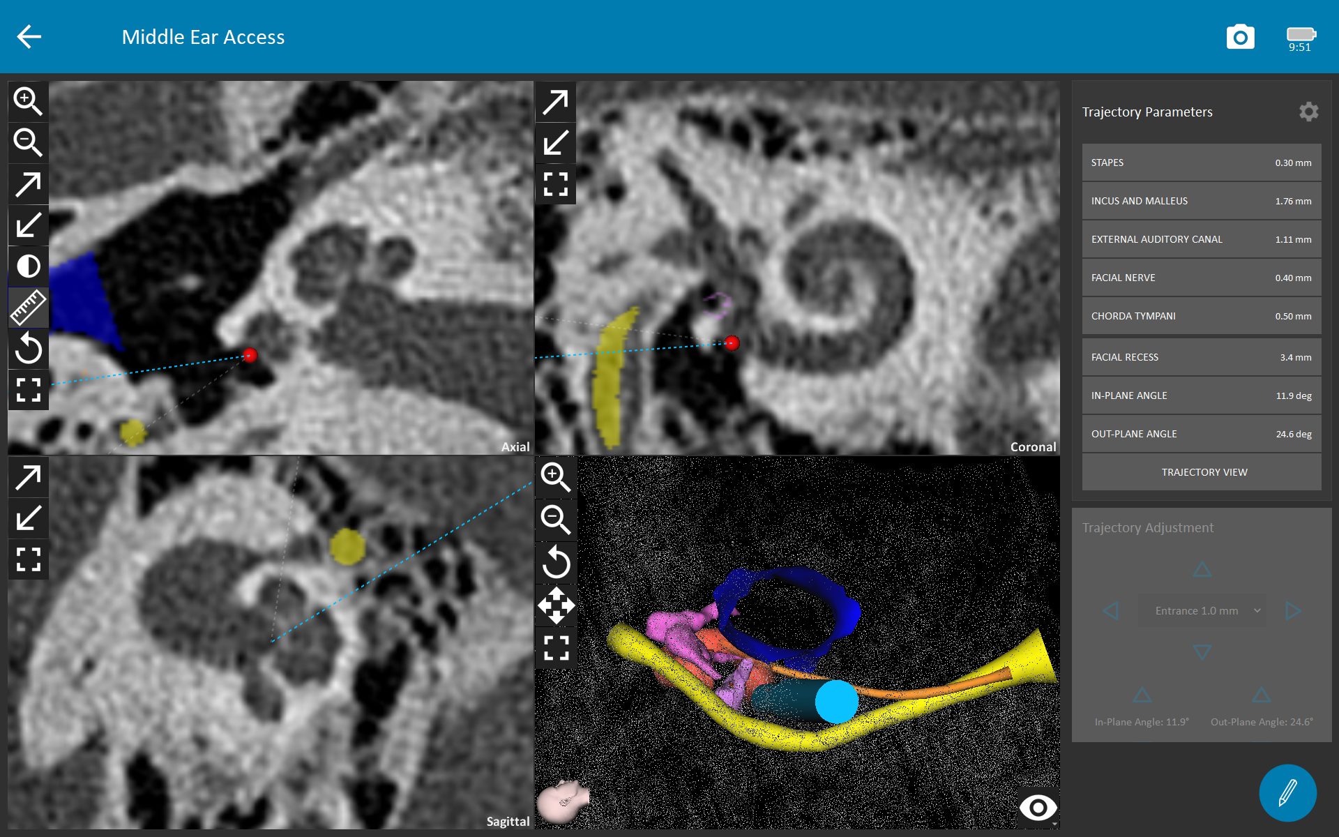 OTOPLAN 3D visualization of otological surgery