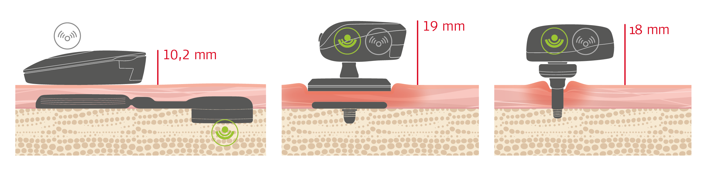 BONEBRIDGE: Wie zuverlässig ist die BONEBRIDGE? Vergleich BB - passiv - perkutan