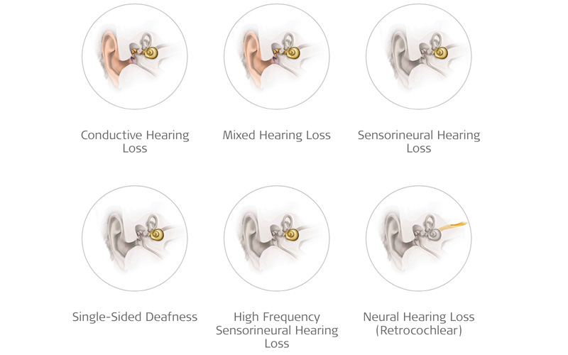 The types of hearing loss include conductive hearing loss, mixed hearing loss, sensorineural hearing loss, single-sided deafness, high frequency sensorineural hearing loss, and neural hearing loss (retrocochlear).