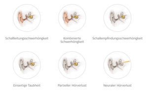 Arten von Hörverlust
