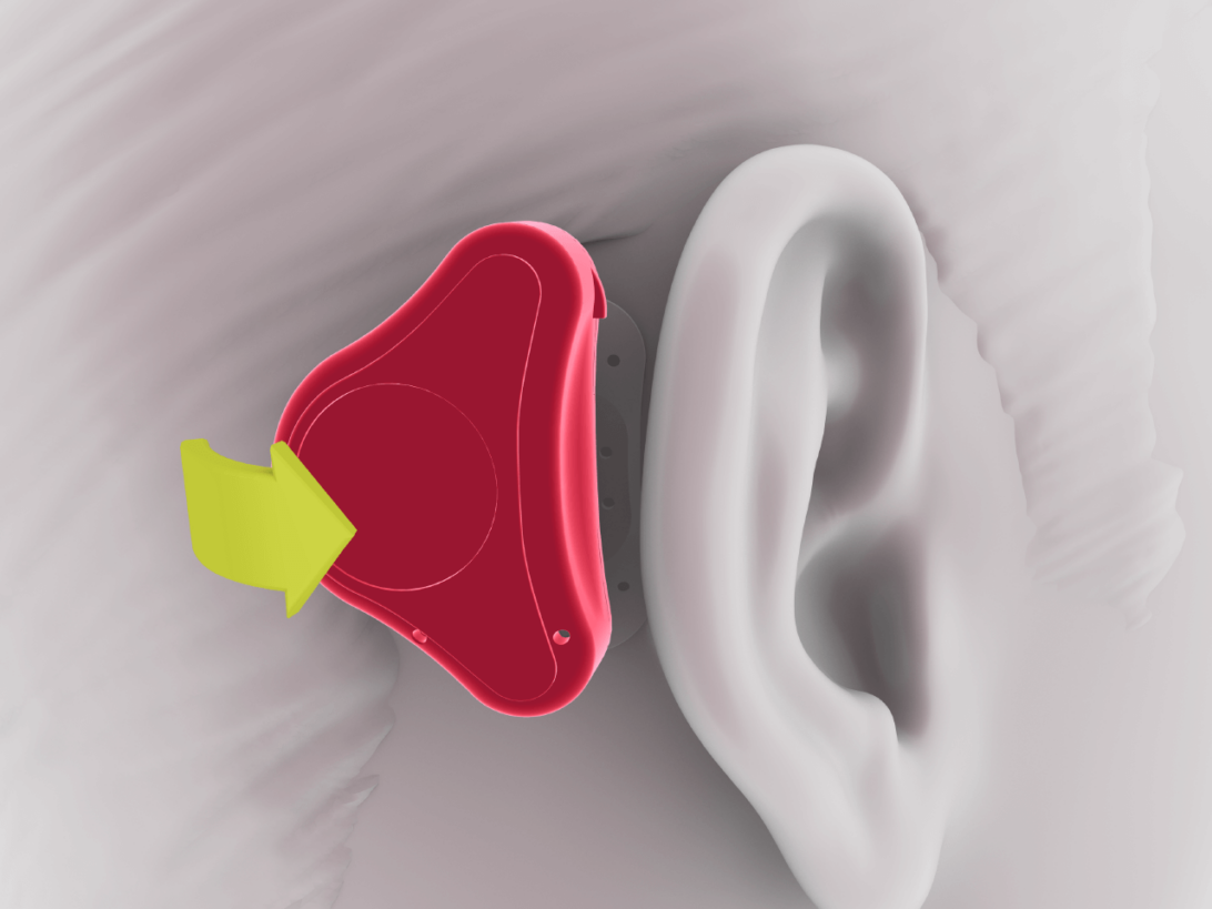 Stick, Click, Hear. Adhear – ADHEAR Knochenleitungshörsystem – HXRBF