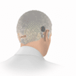 Bone conduction treatment for single-sided deafness