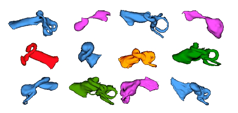 3D Cochlea malformations electrode arrays