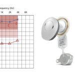 Conductive hearing loss air conduct vs bone conduction air-bone gap