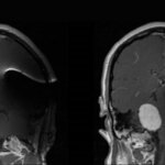 MRI with NF2 and Auditory Brainstem Implant