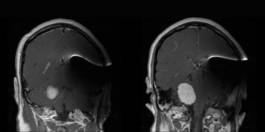 MRI with NF2 and Auditory Brainstem Implant