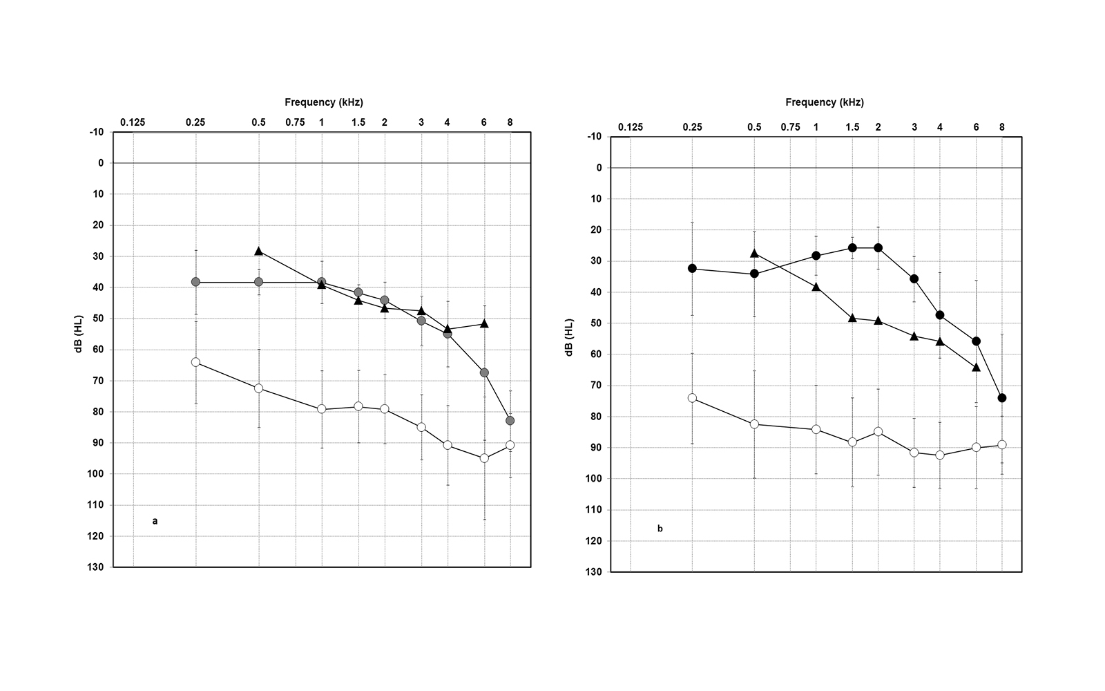 VSB middle ear implant audiogram patients with mixed hearing loss