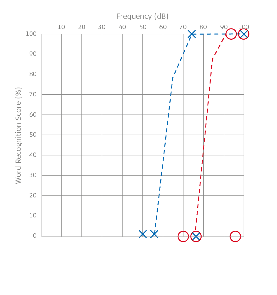 Speech Audiometry: A Child With Microtia and Aural Atresia. This image is an audiogram.