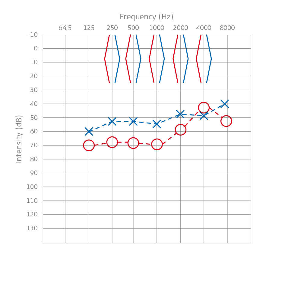 Pure Tone Audiometry: A Child With Microtia and Aural Atresia
