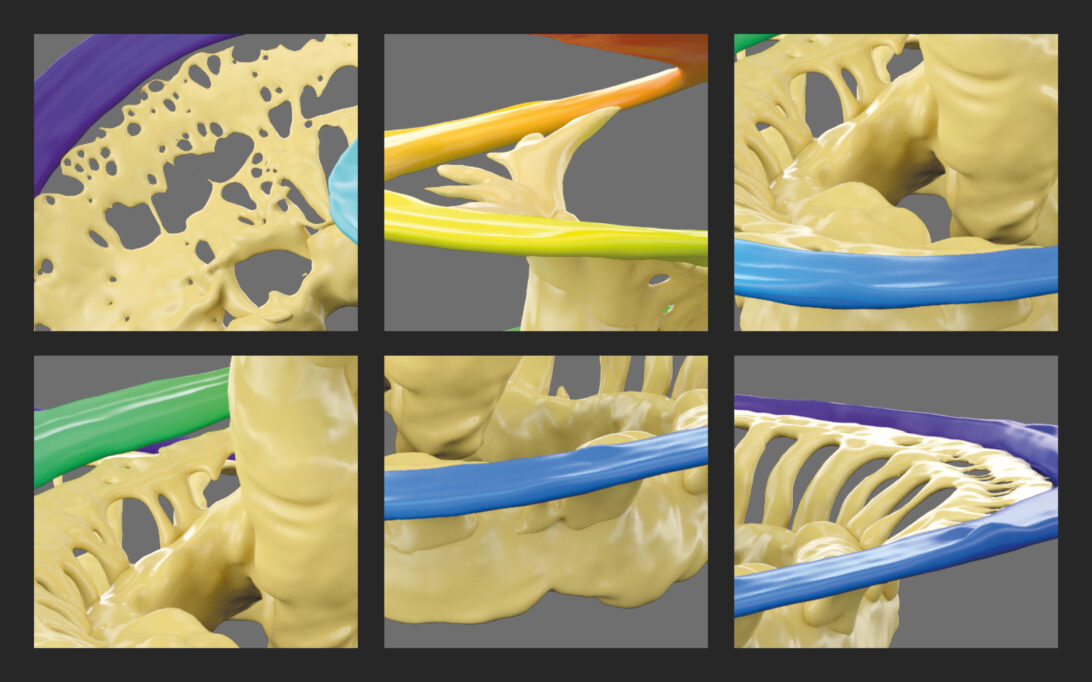 A colorful close-up of the structures of the cochlea reveal how fragile they are, demonstrating the need to Maximize Residual Hearing Preservation With Precision Surgery