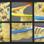 A colorful close-up of the structures of the cochlea reveal how fragile they are, demonstrating the need to Maximize Residual Hearing Preservation With Precision Surgery