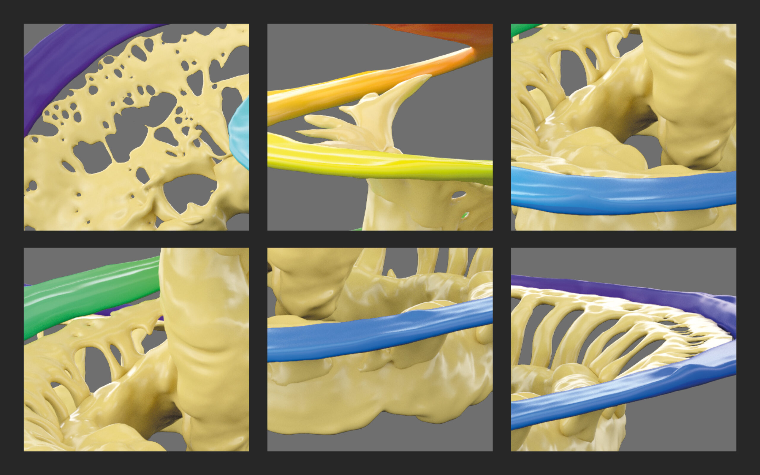 A colorful close-up of the structures of the cochlea reveal how fragile they are, demonstrating the need to Maximize Residual Hearing Preservation With Precision Surgery