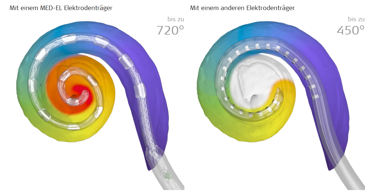 MED-EL Elektrodenträger sind lange genug, um die gesamte Cochlea elektrisch zu stimulieren.