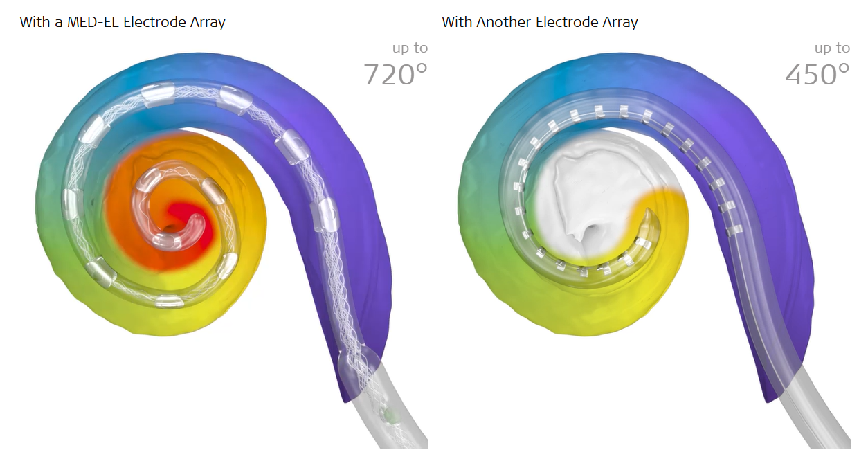 Electrode array insertion depth MED-EL vs. other manufacturer