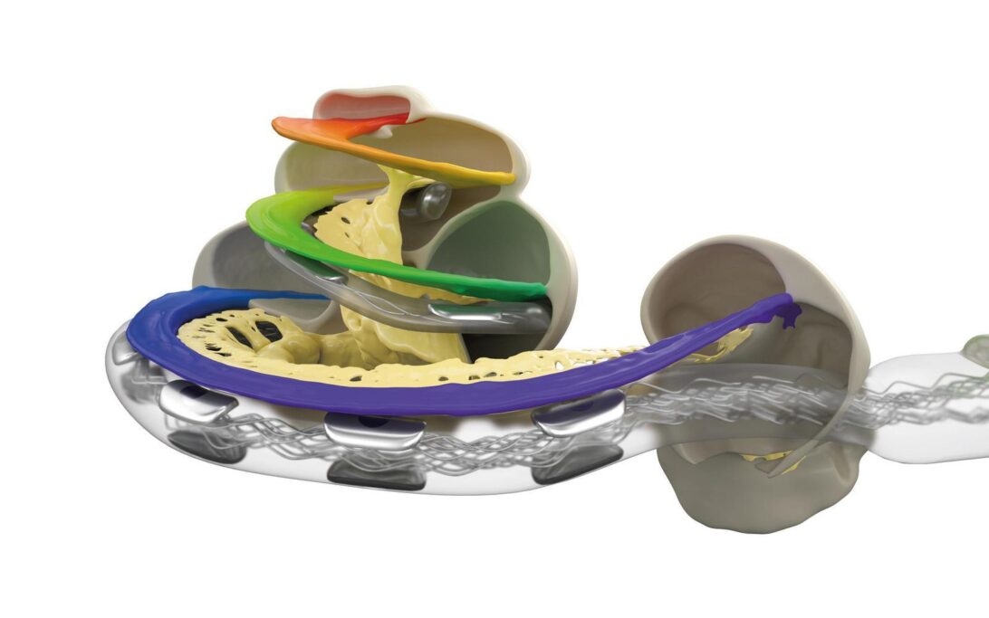 FLEX electrode array inserted into a cochlea