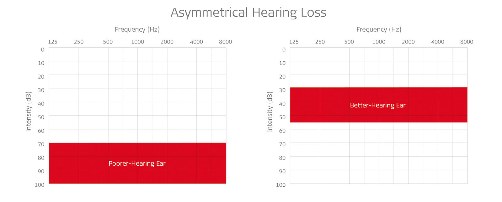 Audiogram showing asymmetrical hearing loss: poorer hearing in one ear than the other.