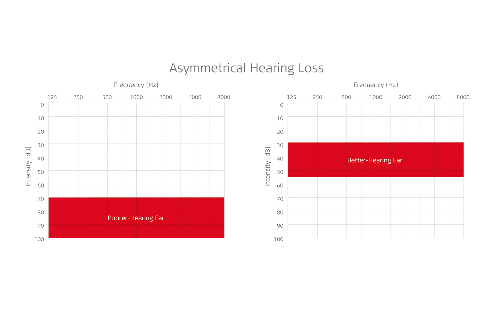 Audiogram showing asymmetrical hearing loss: poorer hearing in one ear than the other.