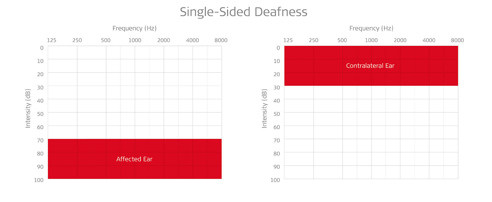 Audiogram showing normal hearing in one ear and profound hearing loss in the other.