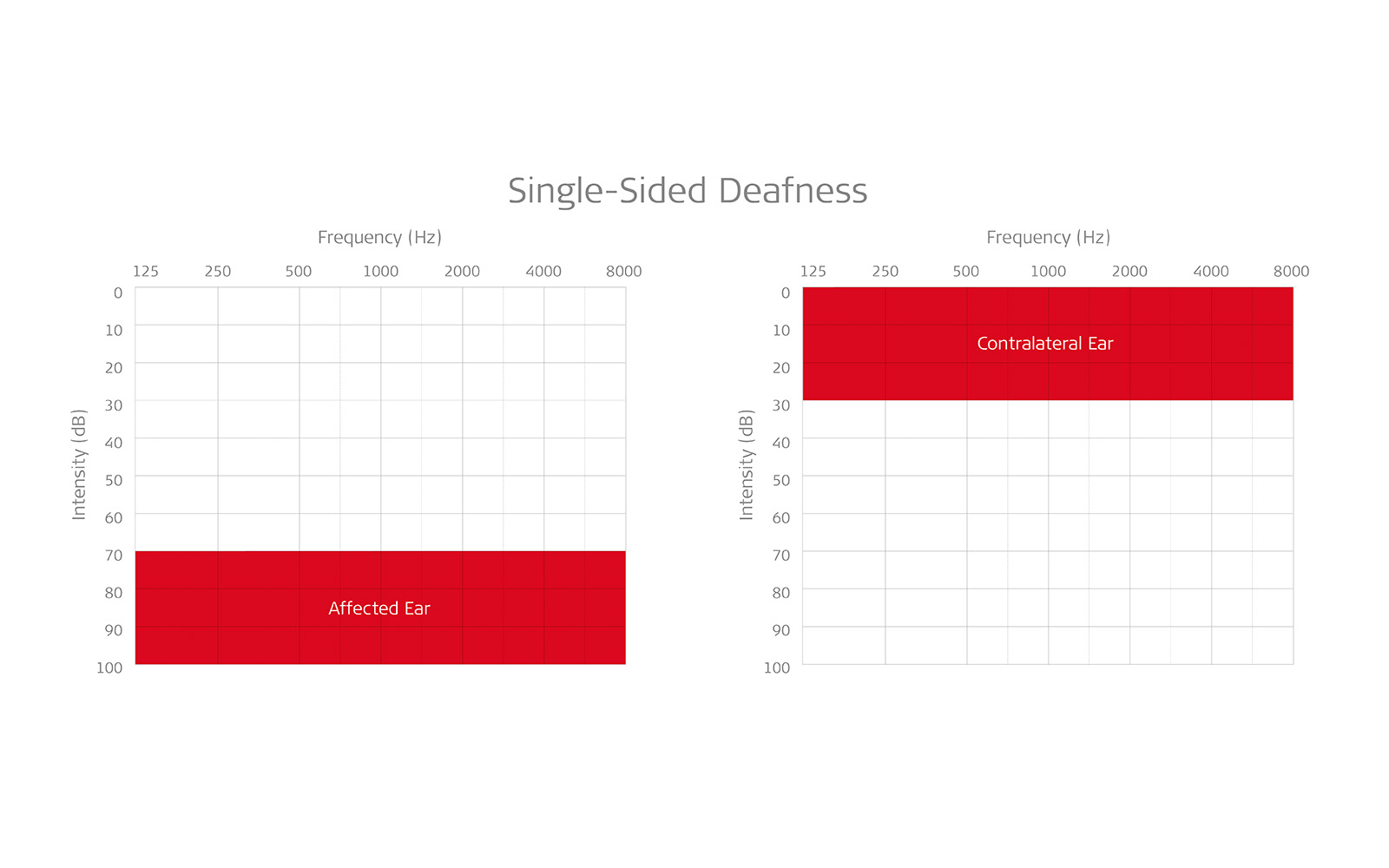 Audiogram showing normal hearing in one ear and profound hearing loss in the other.