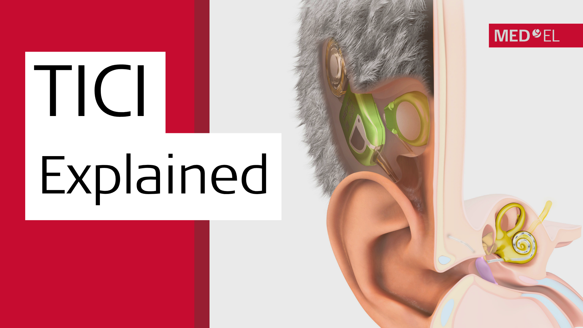 Ear anatomy image with TICI UNICO implant. Text reading "TICI Explained"